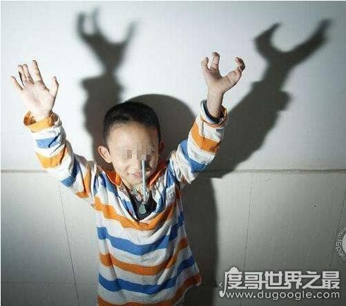 天生畸形的螃蟹手，8岁男童被丢弃三次终被治愈