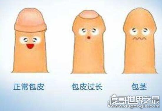 割包为什么很多人后悔，主要有这4点(包茎才需做手术)