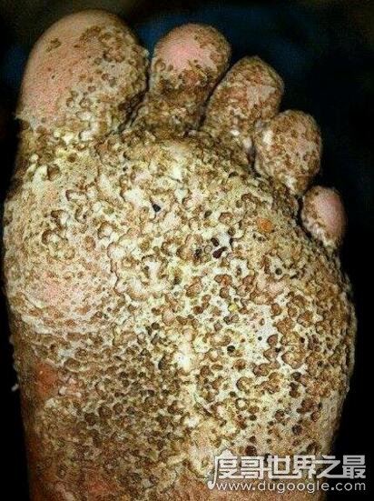 超恶心的密集恐惧症图片大全，密集测试图欢迎挑战(慎入)