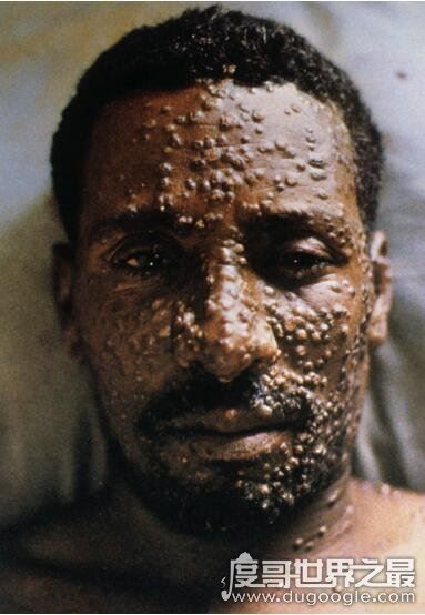 超恶心的密集恐惧症图片大全，密集测试图欢迎挑战(慎入)