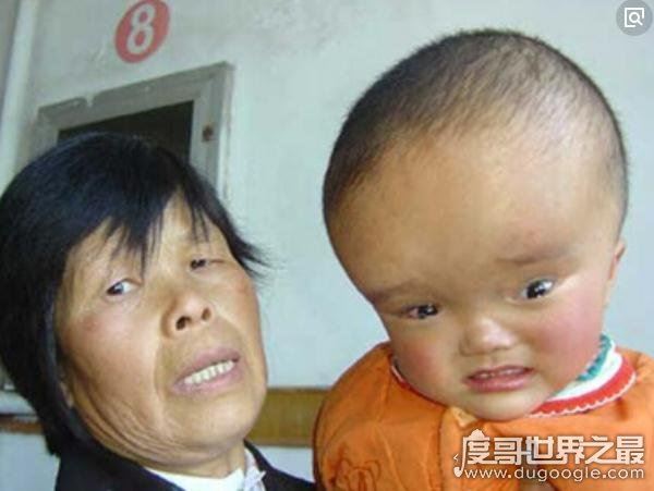 安徽阜阳大头娃娃事件,无良商家生产劣质奶粉害死无辜婴儿