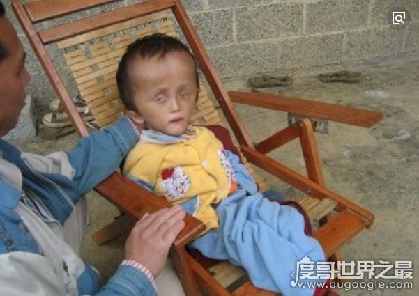 安徽阜阳大头娃娃事件,无良商家生产劣质奶粉害死无辜婴儿