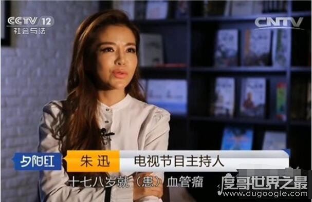 朱迅最近身体怎么样，面黄肌瘦像根竹竿(疑似再次患癌)