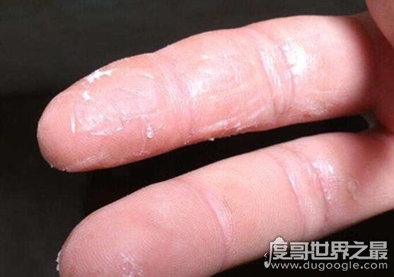 502胶水把手黏住了怎么办，教你几个小妙招轻松分开被黏住的手