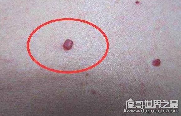 什么叫蜘蛛痣,痣的周围有呈放射性小血管分支(蜘蛛痣图片)