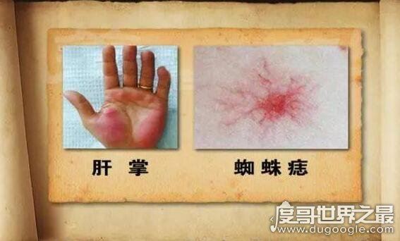 什么叫蜘蛛痣，痣的周围有呈放射性小血管分支(蜘蛛痣图片)