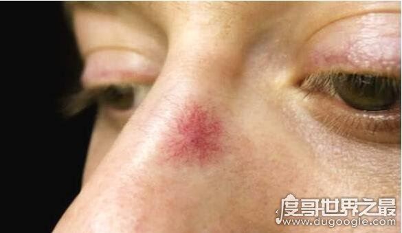 什么叫蜘蛛痣，痣的周围有呈放射性小血管分支(蜘蛛痣图片)