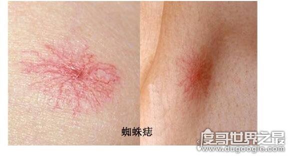 什么叫蜘蛛痣,痣的周围有呈放射性小血管分支(蜘蛛痣图片)
