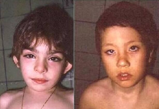 日本歌舞伎面谱综合症，因容貌酷似化妆后的歌舞伎而得名