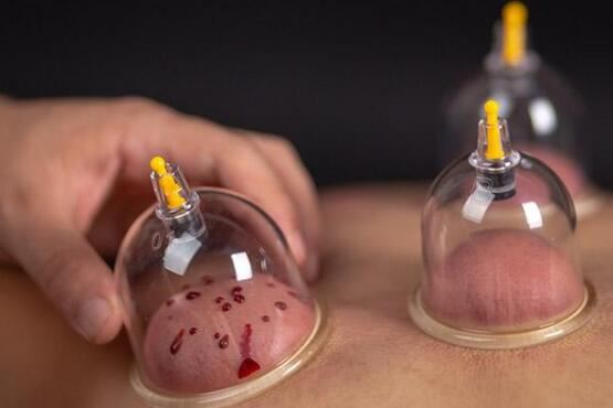 男人排湿气最快的方法，拔罐最快速有效(4种办法)