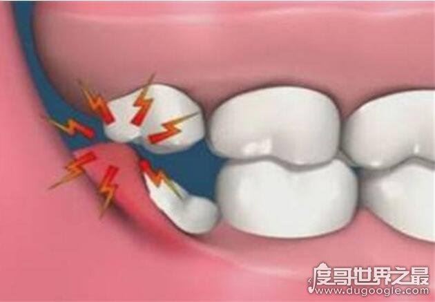 不需要拔的智齿图片，这4种情况下的智齿其实并不需要拔