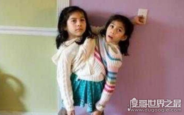 世界上最漂亮的连体人,曾出演电影《大鱼》(坚强独立)