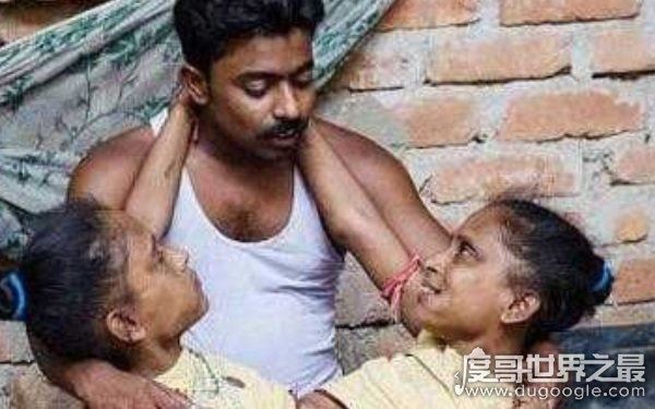 世界上最漂亮的连体人，曾出演电影《大鱼》（坚强独立）