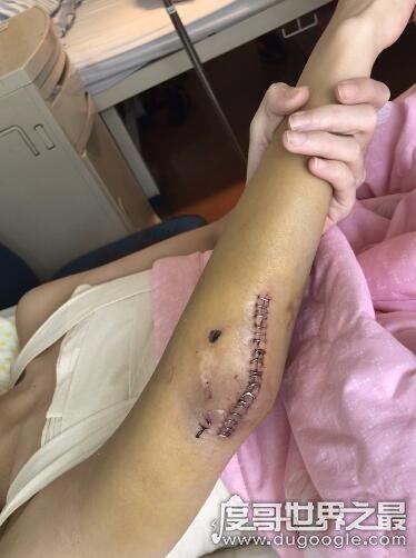 yy夏可可车祸发生经过，夏可可徒弟秦始皇伤重去世