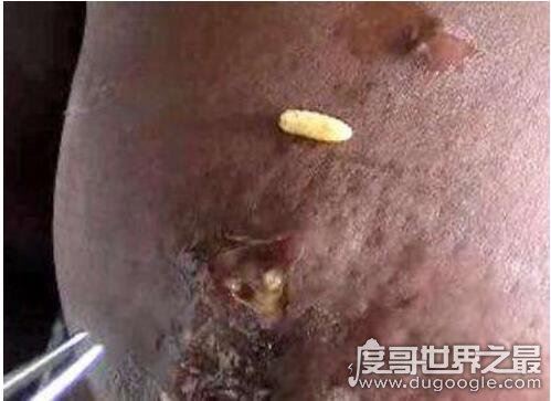 世界十大最恶心皮肤病,皮肤蝇蛆病就是莲蓬乳(图)