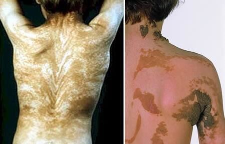 世界十大最恶心皮肤病，皮肤蝇蛆病就是莲蓬乳(图)