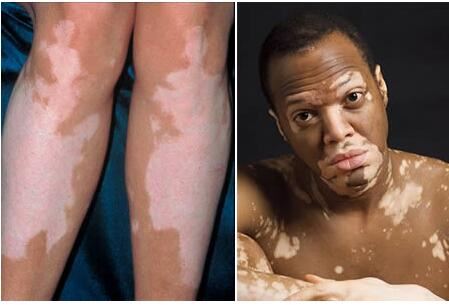 世界十大最恶心皮肤病，皮肤蝇蛆病就是莲蓬乳(图)