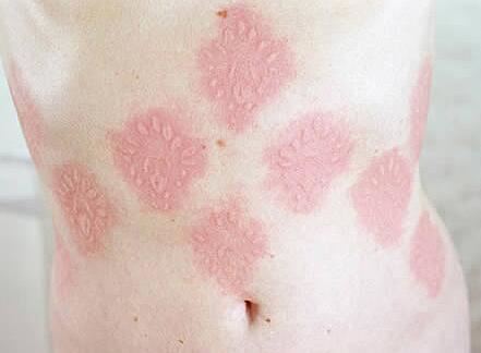 世界十大最恶心皮肤病，皮肤蝇蛆病就是莲蓬乳(图)