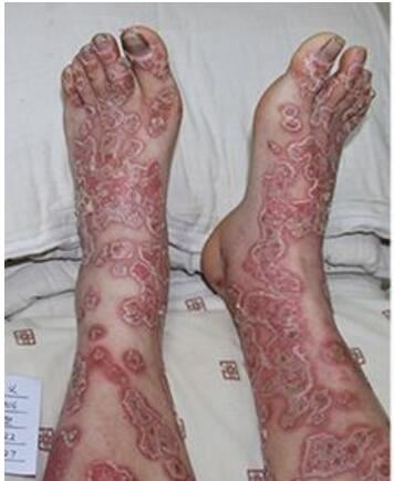 世界十大最恶心皮肤病，皮肤蝇蛆病就是莲蓬乳(图)