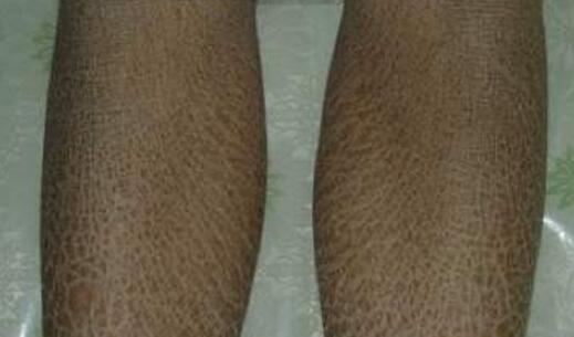 世界十大最恶心皮肤病，皮肤蝇蛆病就是莲蓬乳(图)