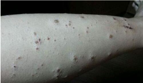 世界十大最恶心皮肤病，皮肤蝇蛆病就是莲蓬乳(图)