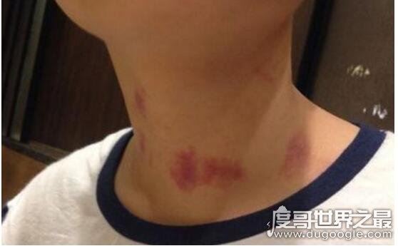 吻痕怎么快速消除，教你5招快速消除吻痕的方法