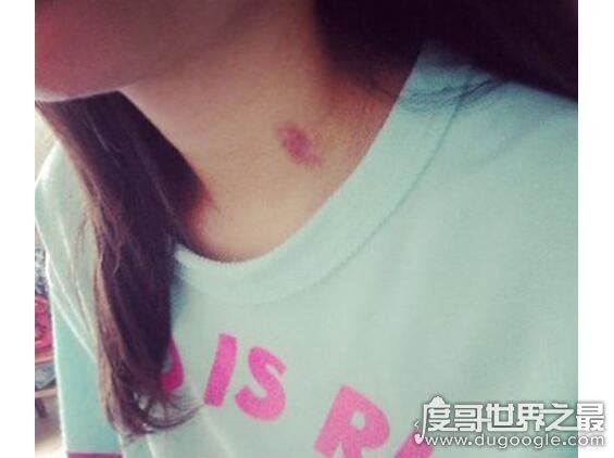 吻痕怎么快速消除，教你5招快速消除吻痕的方法