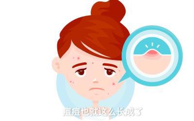 为什么痘痘老是反复光临