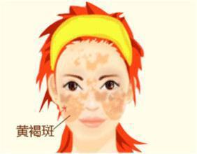 面部黄褐斑怎么治疗