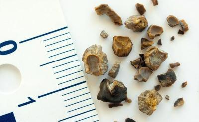 治疗肾结石最好的偏方