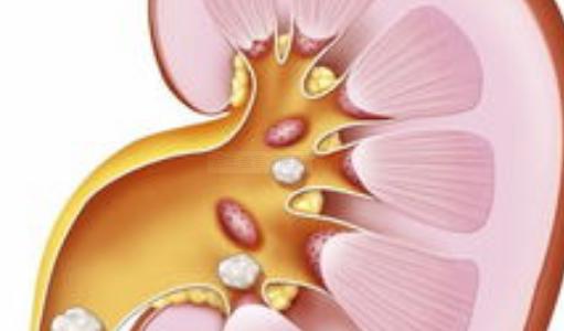 治疗肾结石最好的偏方