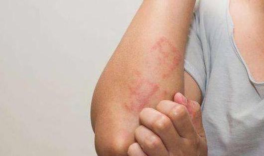 鸡蛋过敏怎么脱敏治疗