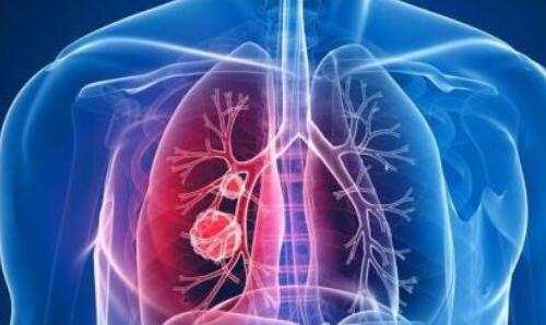 肺癌手术风险有多大