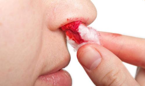 鼻出血的正确止血方法有哪些