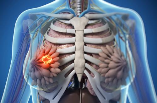 乳腺癌早期症状图片 教你识别乳腺癌