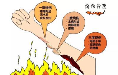 烧伤:如何治疗一度,二度和三度烧伤