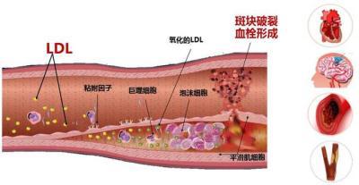 动脉硬化吃什么好你知道吗?