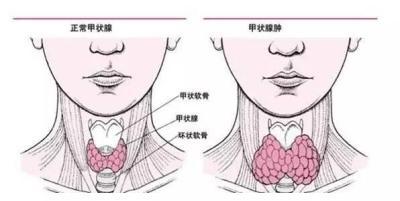 甲状腺肿大吃什么不好?