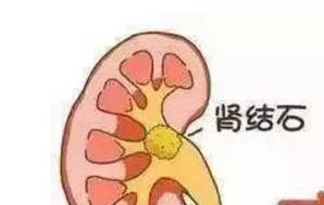 引起肾结石的4大罪魁祸首，怎样预防肾结石？
