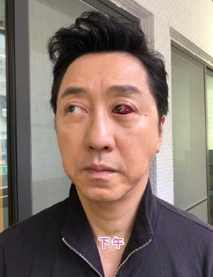 庾澄庆眼睛受伤在微博晒出眼睛受伤的照片 这个受伤的眼睛好吓人