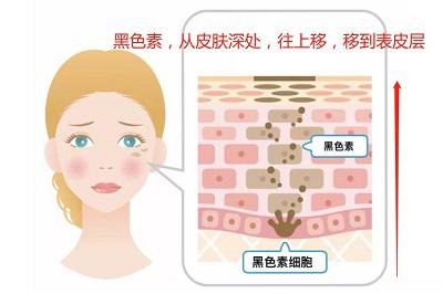 黑色素瘤早期症状图片 告诉你三大症状