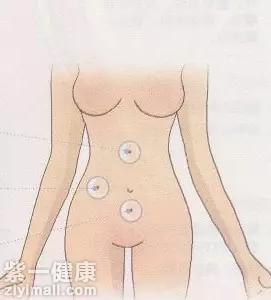 拔罐减肥穴位有哪些 【详解】拔罐减肥位置图