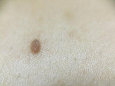 脖子上长小肉疙瘩怎么回事？