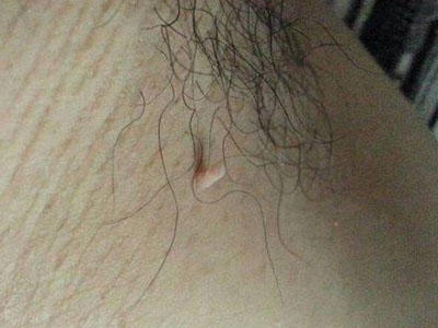 脖子上长小肉疙瘩怎么回事?
