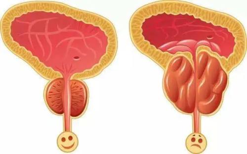 男性前列腺炎能过性生活吗?需要注意什么