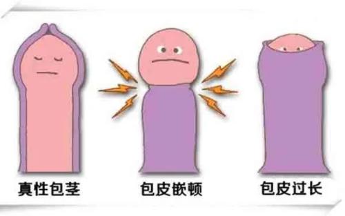 科普|包皮,你割了吗