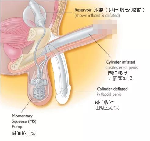 丁丁又软又短怎么办?这个神器让你随心所欲