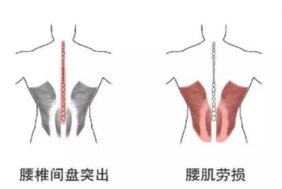 性生活到底跟腰有什么关系