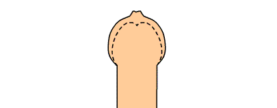 割包皮可以提高性能力吗