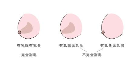 女生可能不止有一对乳房,副乳也能分泌乳汁